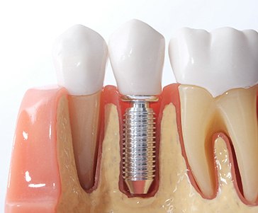 Osseointegration is when your dental implant fuses with your jawbone