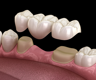 Illustration of dental bridge used to replace missing teeth