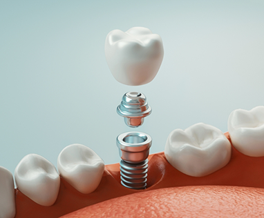 Illustration of dental implant, crown, and abutment being placed